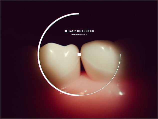 Representación de cómo la detección óptica de espacios interdentales de Dyson detecta los espacios entre los dientes.