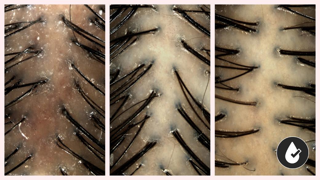 Imagini înainte, în timpul și după utilizarea tratamentului Dyson Amino pentru scalp, cu bule și fără clătire.