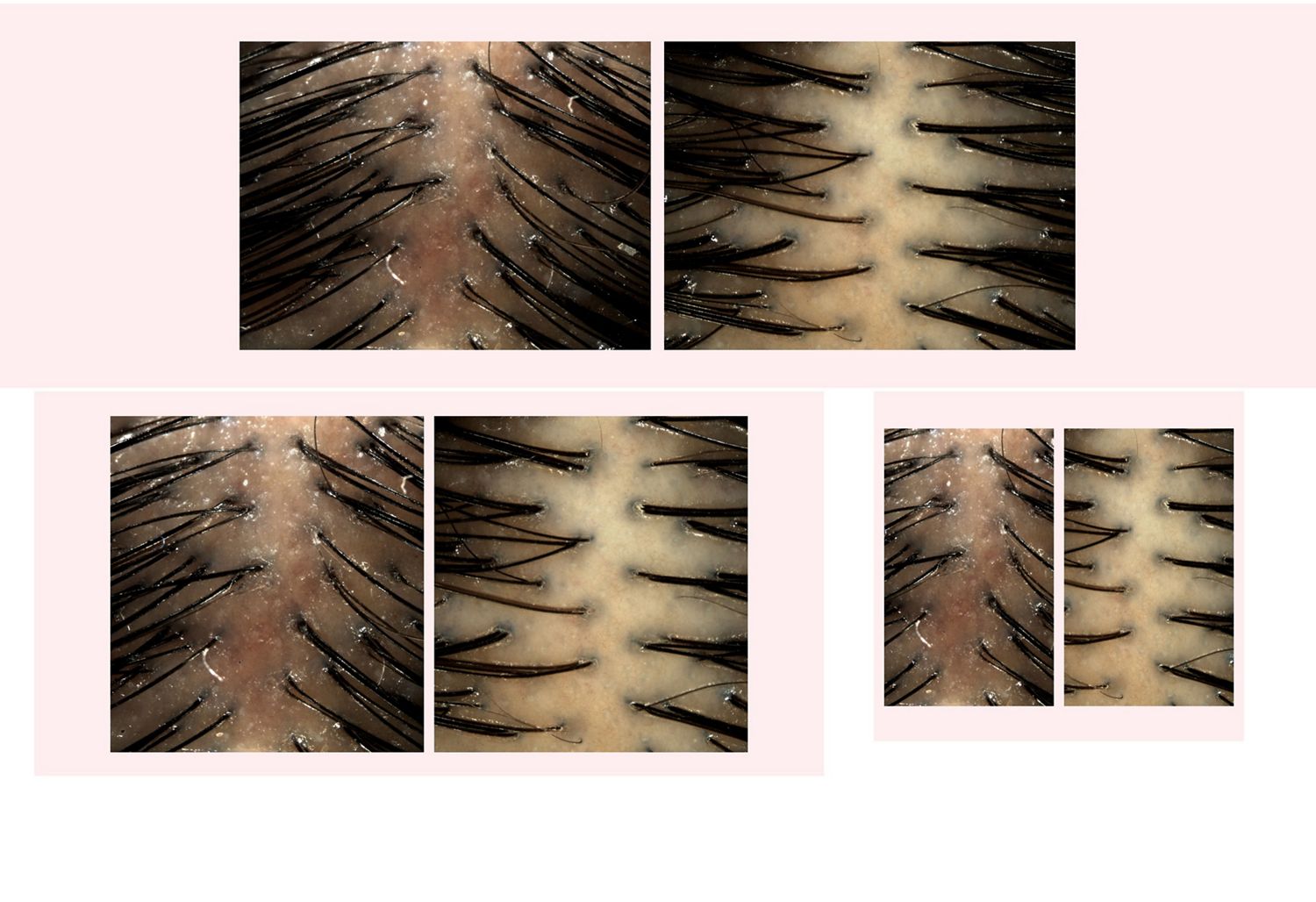 Before and after imagery of Dyson Amino leave-in scalp bubble treatment used on a scalp.