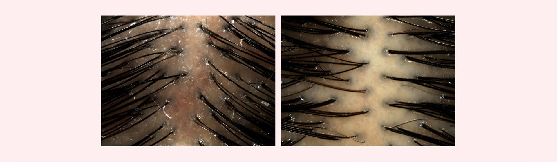 Before and after imagery of Dyson Amino leave-in scalp bubble treatment used on a scalp.