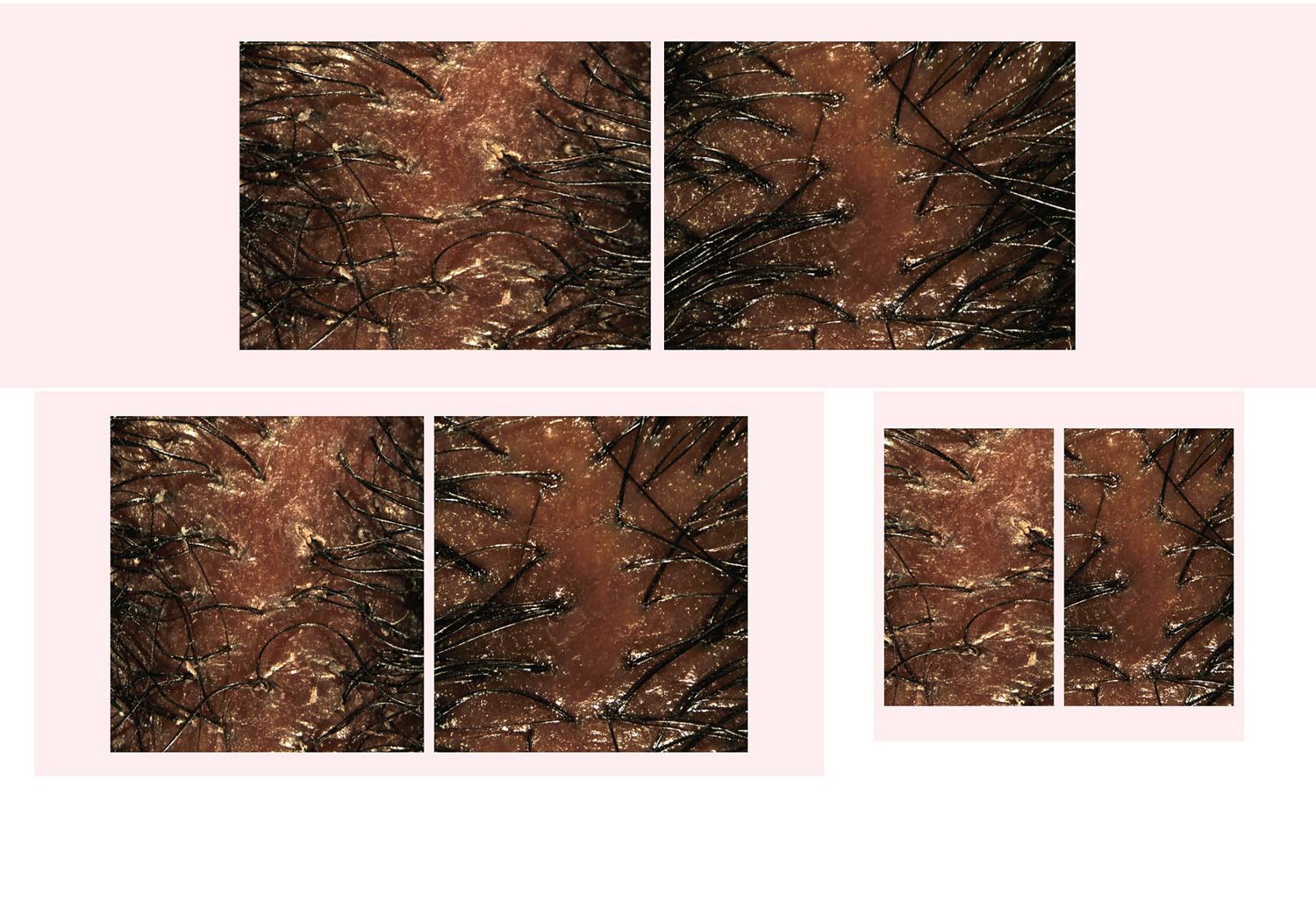 Before and after imagery of Dyson Amino leave-in scalp bubble treatment used on a dry scalp.