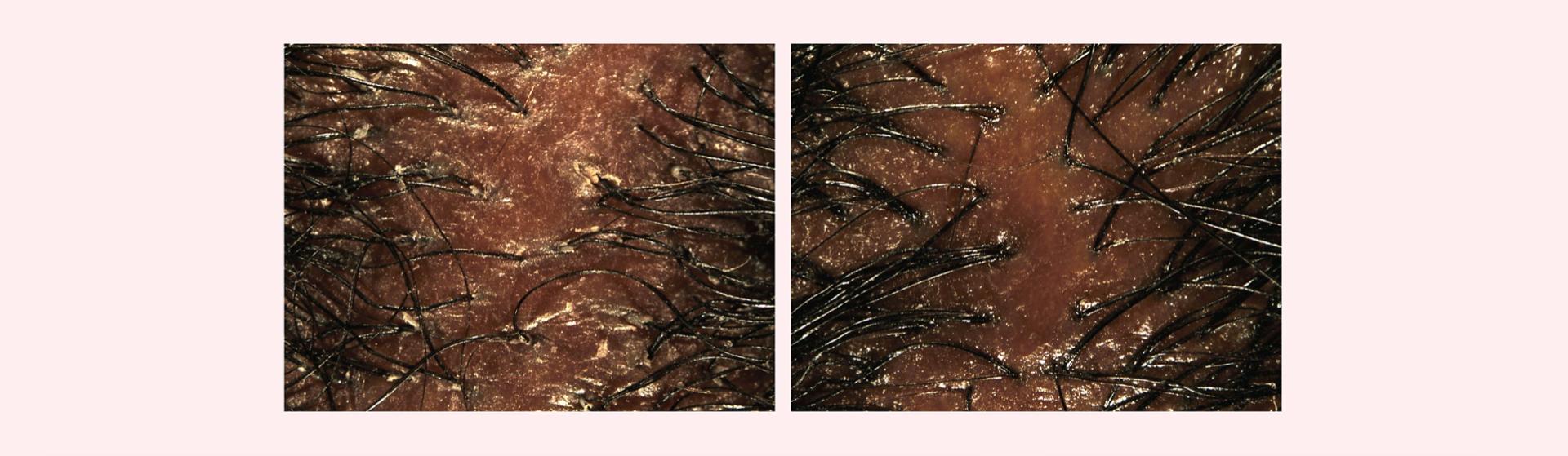 Before and after imagery of Dyson Amino leave-in scalp bubble treatment used on a dry scalp.