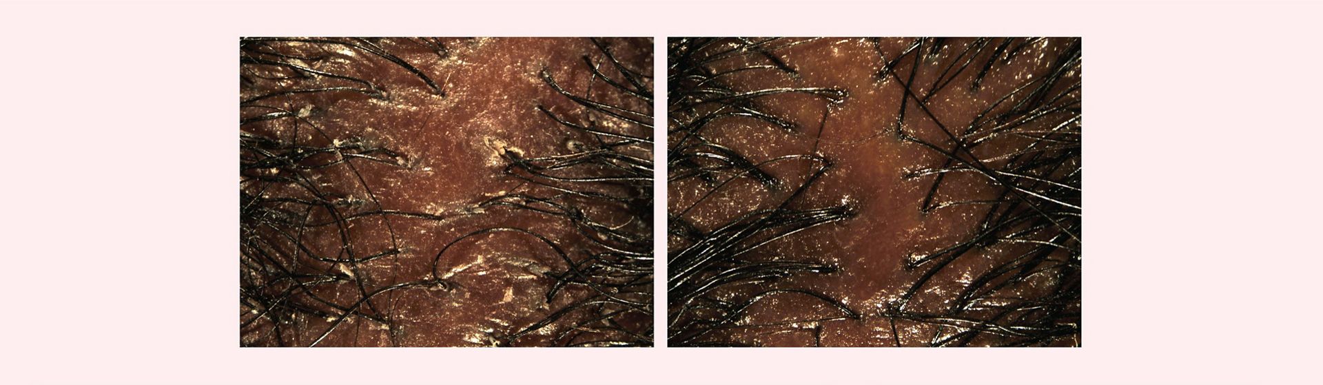 Before and after imagery of Dyson Amino leave-in scalp bubble treatment used on a dry scalp.