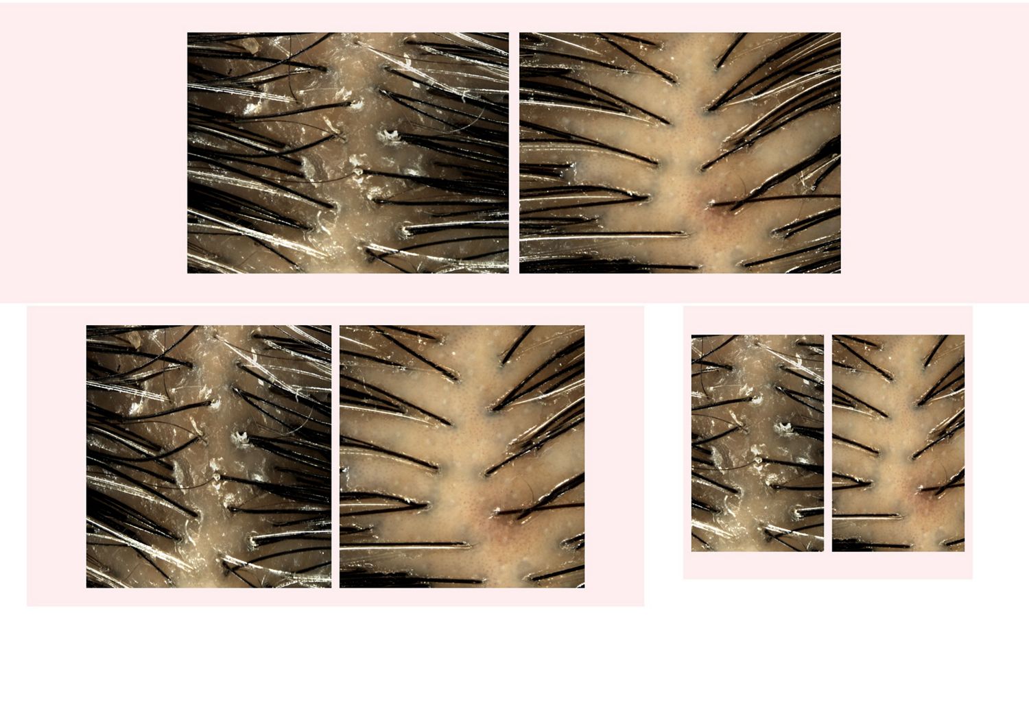 Before and after imagery of Dyson Amino leave-in scalp bubble treatment used on a flaky scalp.