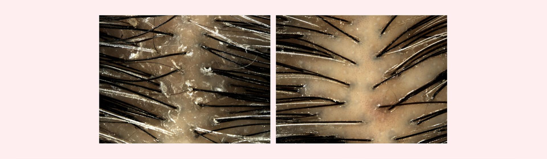 Before and after imagery of Dyson Amino leave-in scalp bubble treatment used on a flaky scalp.