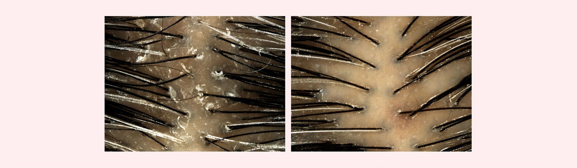 Before and after imagery of Dyson Amino leave-in scalp bubble treatment used on a flaky scalp.
