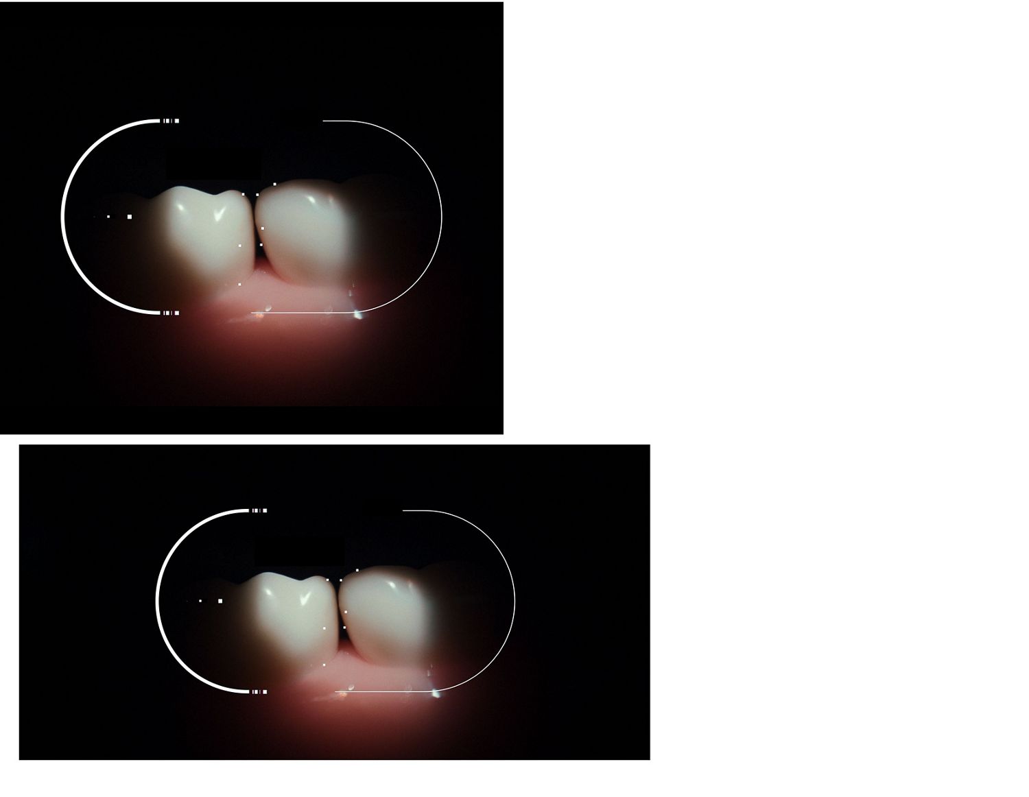 歯間を検知するダイソンのGap Optical Targetingのカメラビュー。